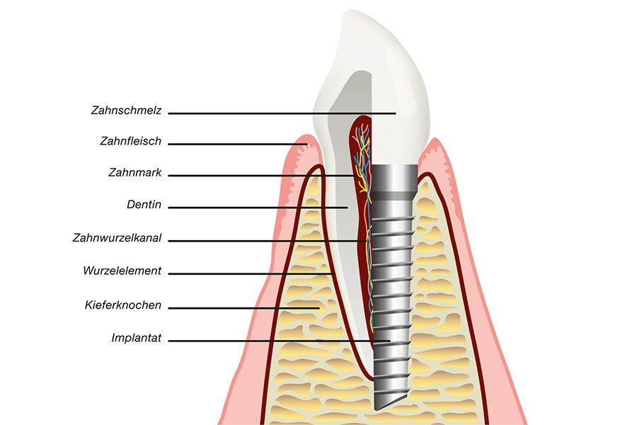 Zahnimplantate